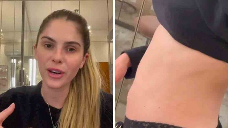 Bárbara Evans mostra efeitos no corpo após primeira captação para fertilização