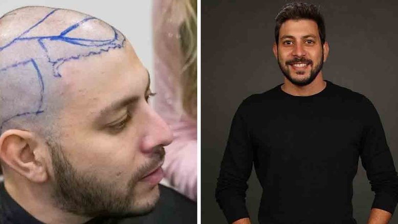 Ex-BBB Caio passa por procedimento de transplante capilar