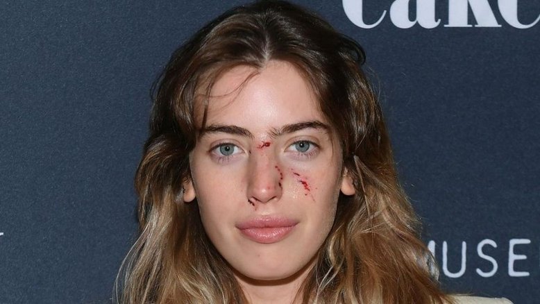 Clara McGregor é mordida no rosto por cachorro minutos antes de evento