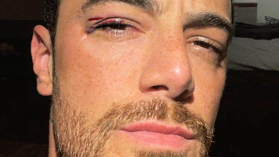 Felipe Titto se machuca após bater rosto em janela de carro