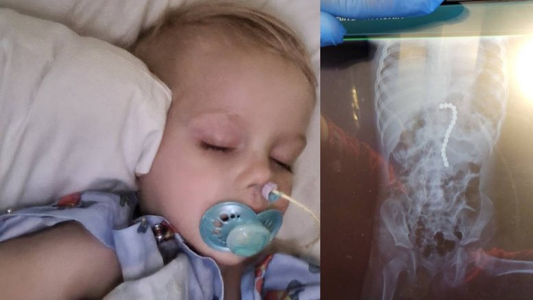 Criança de 2 anos passa por cirurgia após engolir 16 ímãs