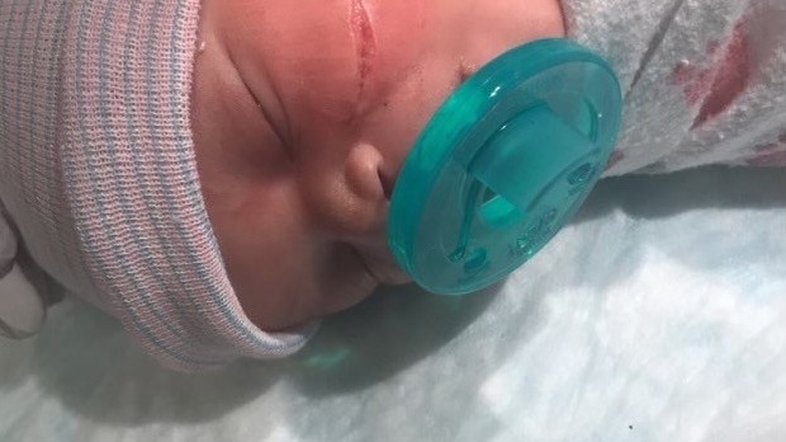 Recém-nascida tem o rosto cortado durante cesárea de emergência