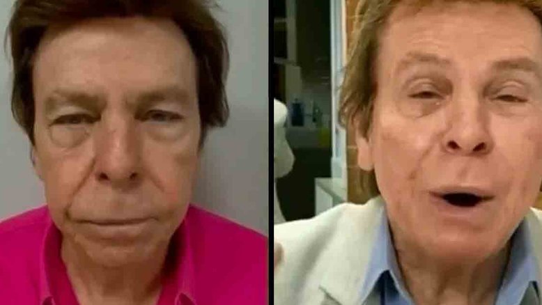 Nelson Rubens mostra resultado de harmonização facial: ‘Eu gostei’