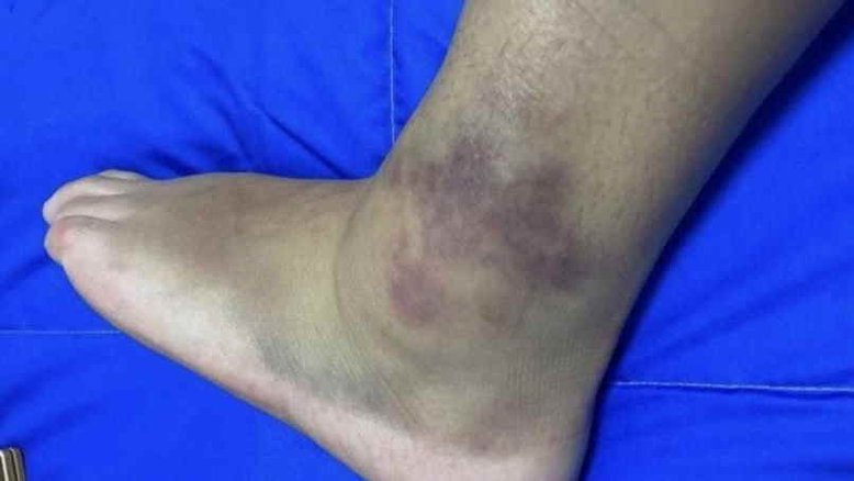 Pâmela Rosa lamenta eliminação e mostra tornozelo inchado: "Não vim 100%'