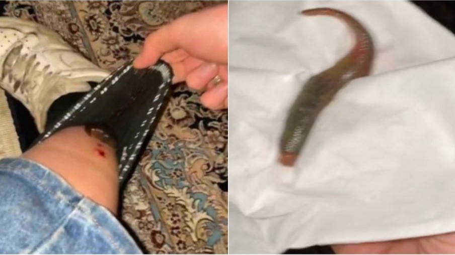 Vídeo: Jovem descobre sanguessuga na meia ao sentir desconforto na perna