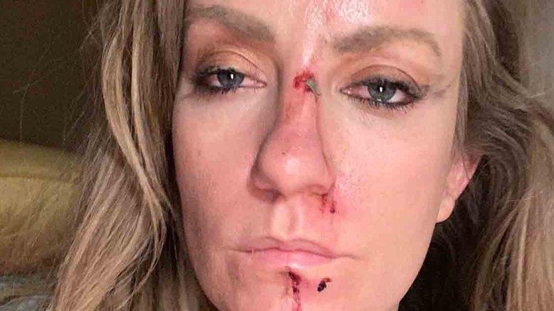 Cantora mostra marcas de violento ataque de motorista de aplicativo
