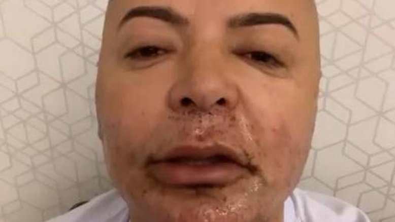 David Brazil mostra resultado de implante capilar: 'Me sentindo a Gretchen'