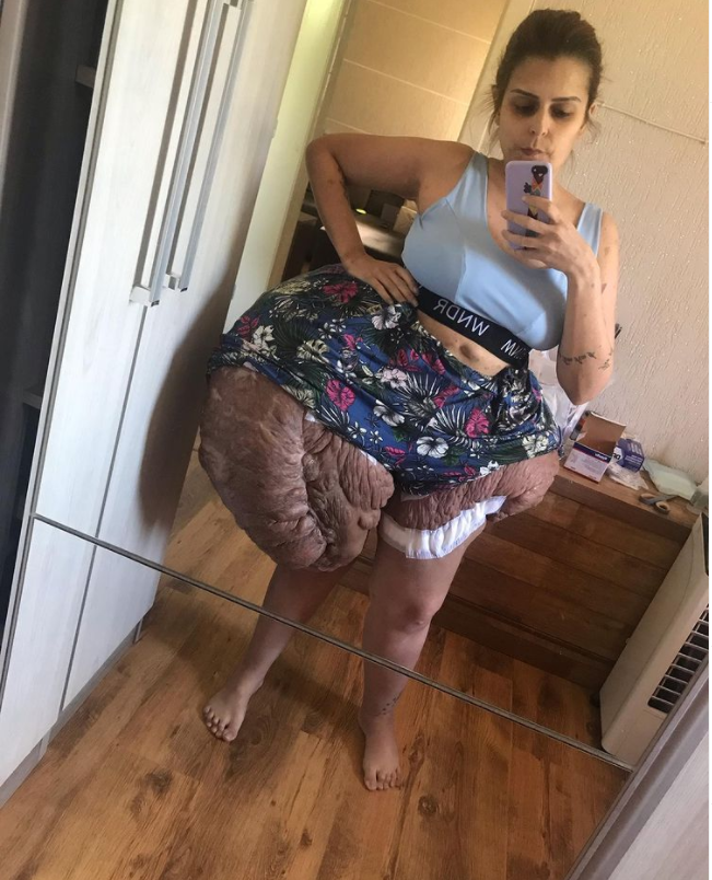 Graças ao empenho na internet, mulher com tumor de 35 kg passará por cirurgia 2 Graças ao empenho na internet, mulher com tumor de 35 kg passará por cirurgia