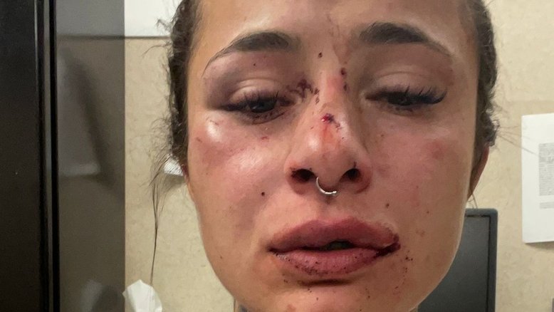 Tatuadora brasileira é espancada por namorado nos EUA e pede ajuda nas redes sociais
