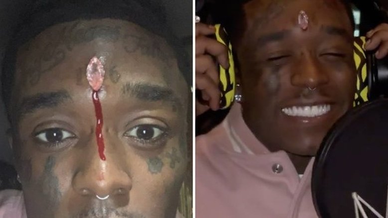 Diamante de R$ 120 milhões implantado na testa de rapper é arrancado em show