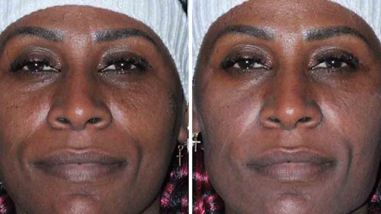 Pepê e Neném passam por harmonização facial