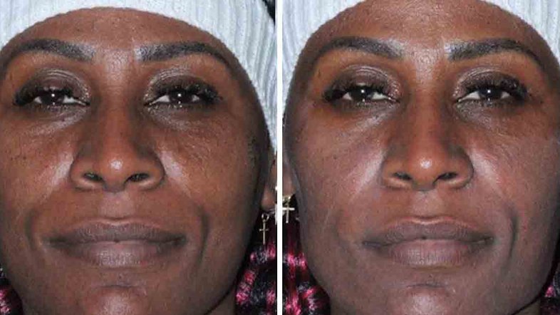 Pepê e Neném passam por harmonização facial