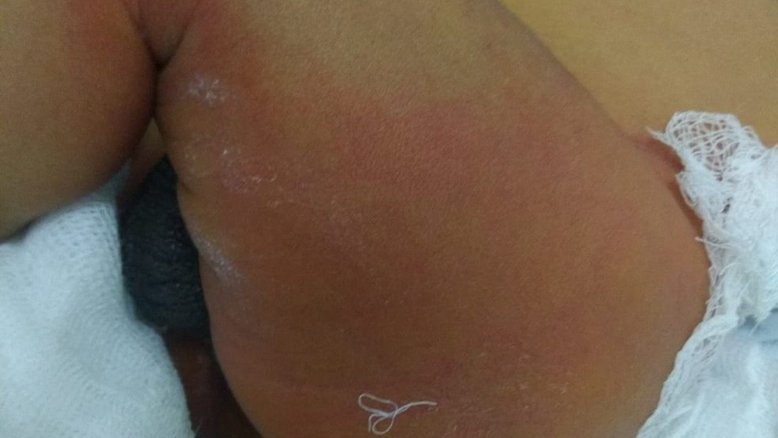 Recém-nascido tem 16% do corpo queimado em banho de hospital no Ceará
