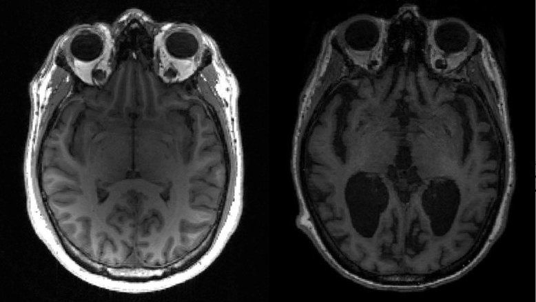 Novo medicamento que retarda progressão do Alzheimer em estágios iniciais é aprovado nos EUA