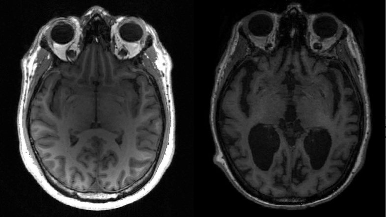 Remédio contra Alzheimer se provou eficaz, diz painel da FDA