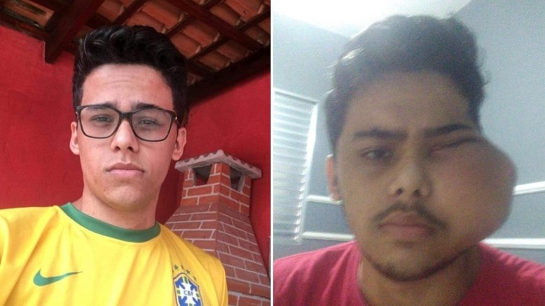 Jovem de 18 anos perde um olho e luta contra tumor raro