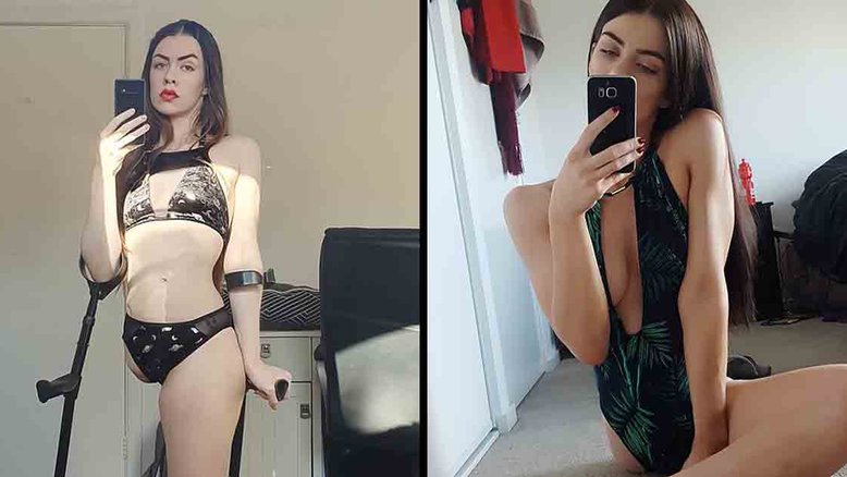 Modelo é acusada de forjar amputação com Photoshop