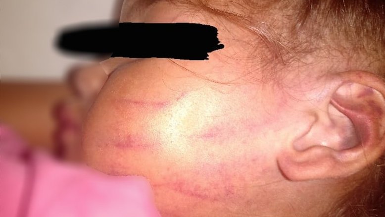 SP: Mãe diz que criança de 2 anos foi agredida em creche