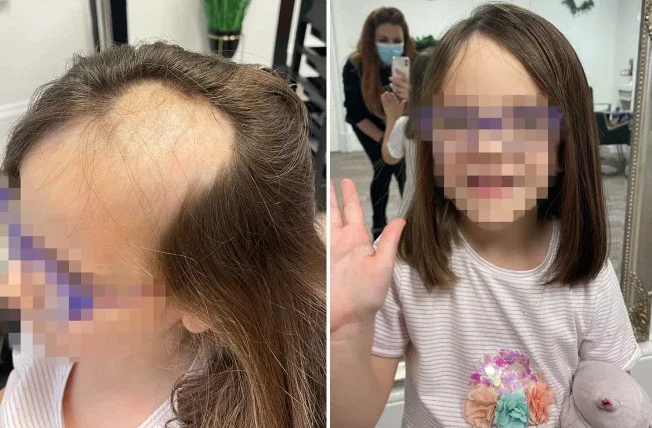 Garota perde cabelo após ele ficar preso em batedeira elétrica enquanto ela fazia bolo