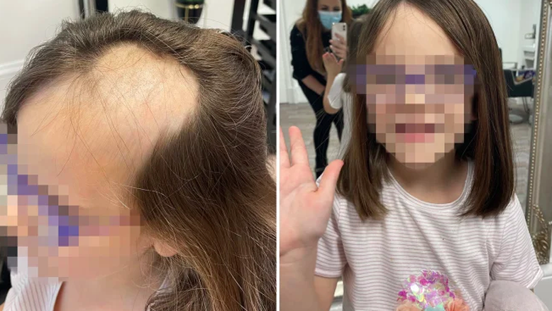 Garota perde cabelo após ele ficar preso em batedeira elétrica enquanto ela fazia bolo