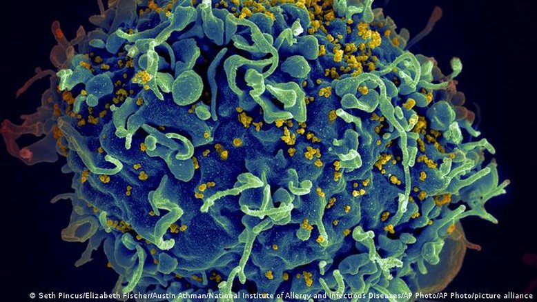 Paciente teria se curado do HIV com imunidade natural