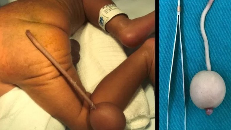 Reprodução Journal of Pediatric Surgery Case Reports