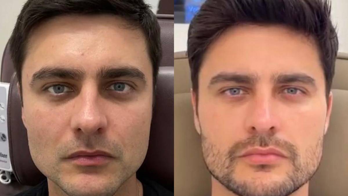 Guilherme Leicam faz harmonização facial e botox no rosto todo