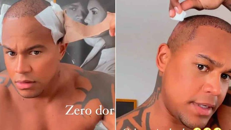 Leo Santana passa por novo implante capilar