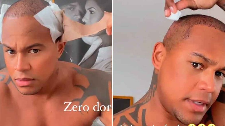 Leo Santana passa por novo implante capilar