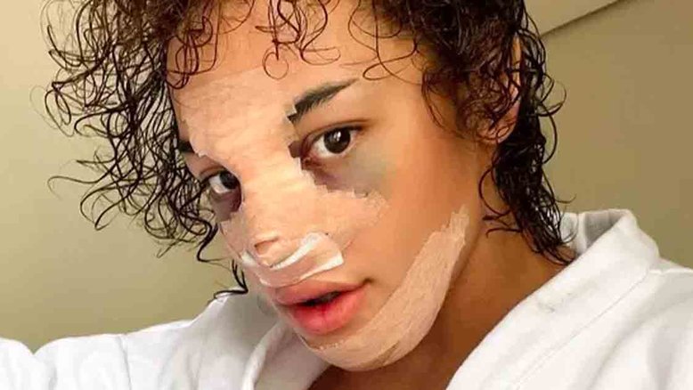 Pabllo Vittar mostra rosto inchado e curativos após rinoplastia