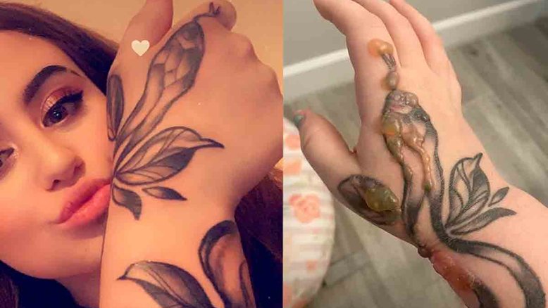 Grávida fica horrorizada quando verrugas começam a crescer na tatuagem de sua mão