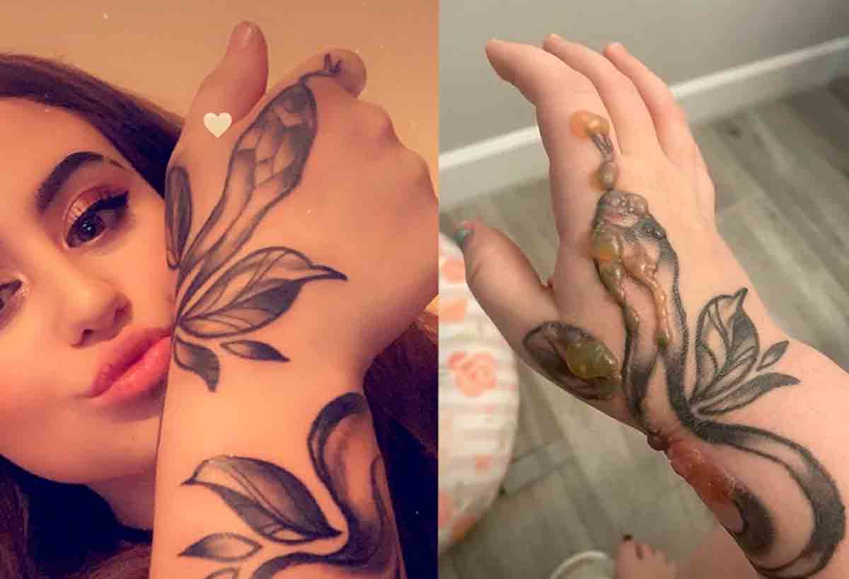 Grávida fica horrorizada quando verrugas começam a crescer na tatuagem de sua mão
