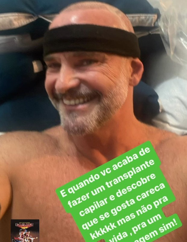 Mateus Carrieri faz transplante capilar e diz que 'se gosta careca' em algumas ocasiões 4 Mateus Carrieri faz transplante capilar e diz que 'se gosta careca' em algumas ocasiões
