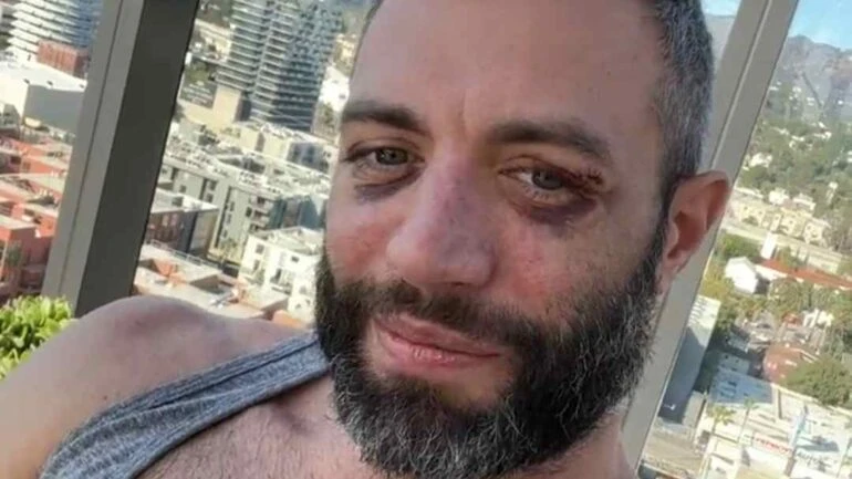 Cole Connor, ator pornô gay, é atacado: ʽSó queriam baterʽ