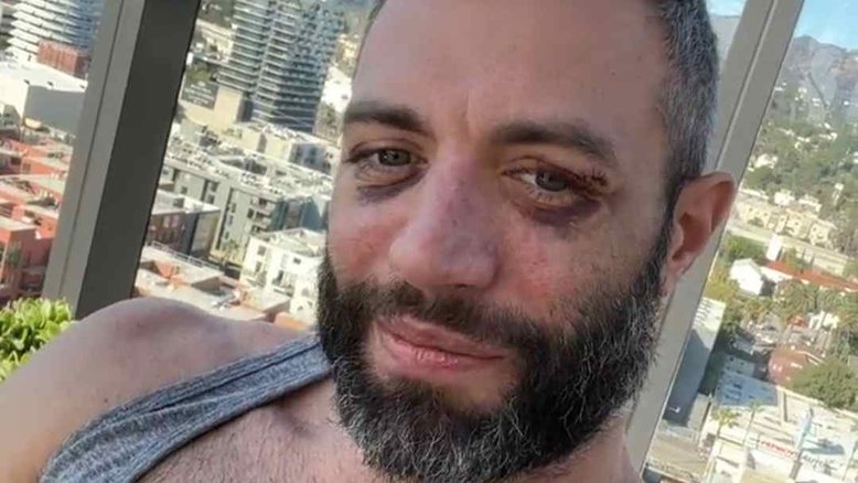 Cole Connor, ator pornô gay, é atacado: ʽSó queriam baterʽ