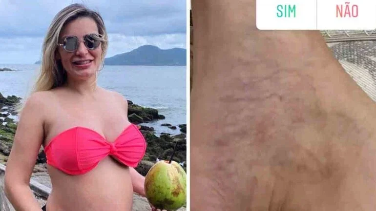 Grávida, Andressa Urach mostra fotos de varizes no pé