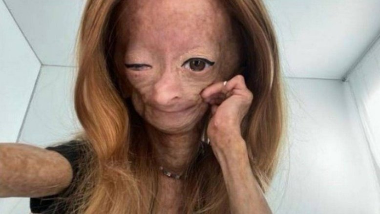 Aos 15 anos, morre Adalia Rose, que sofria da doença de Benjamin Button