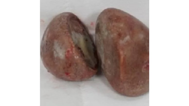 Reprodução/Urology Case Reports