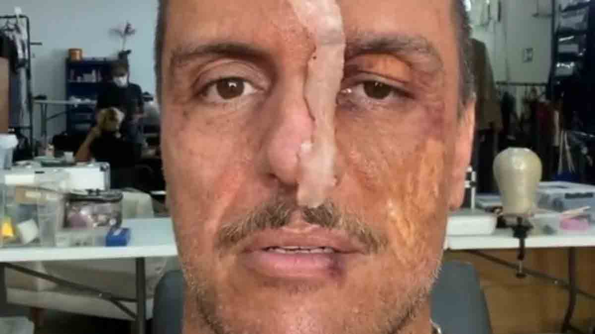 Rodrigo Lombardi assusta fãs ao aparecer com 'rosto queimado' em vídeo