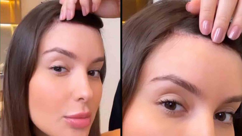 Thais Braz mostra cicatriz de cirurgia para reduzir a testa: ‘Bem fininha’