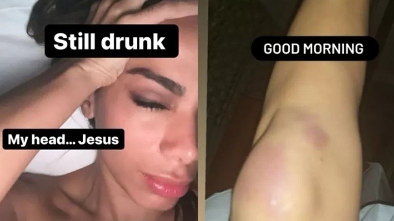 Anitta faz relato após sua festa de aniversário: 'Ainda bêbada e tudo dói'