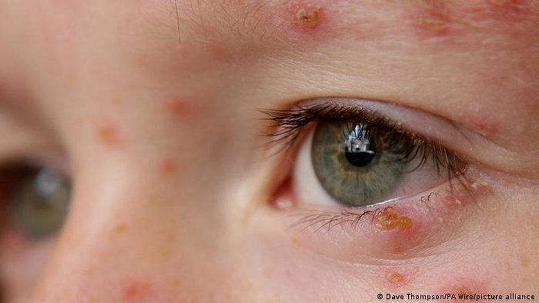 Por que o vírus da herpes se reativa