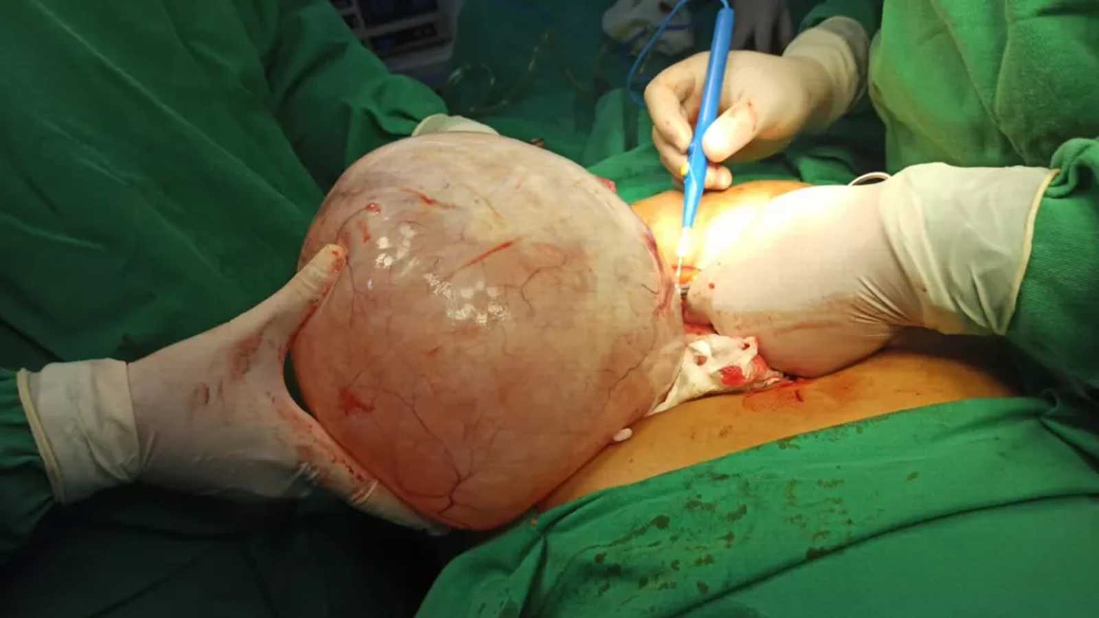 Integra Cirurgia - A remoção de um ou dos dois ovários, chama-se