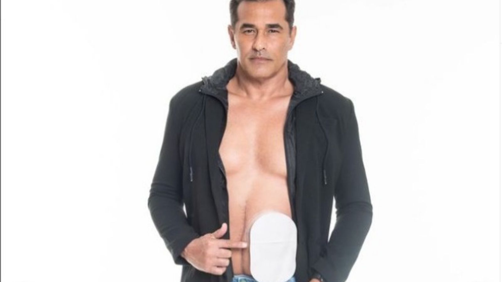 Luciano Szafir mostrando bolsa de colostomia