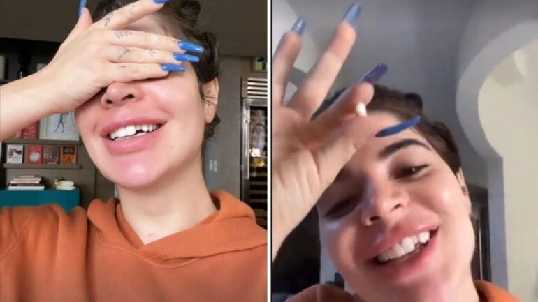 Gkay danifica lente de contato dental durante a noite