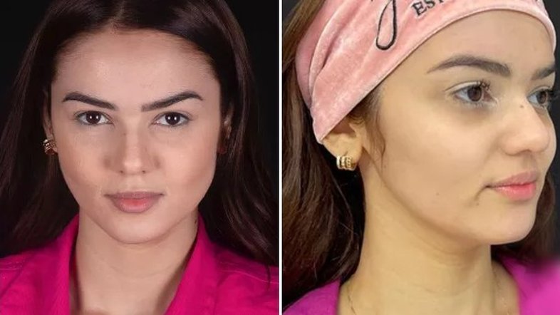 Eslovênia antes da harmonização facial