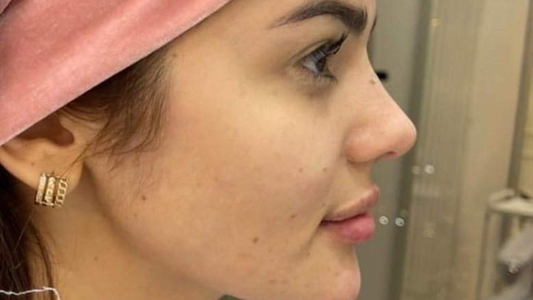 Ex-BBB Eslovênia mostra antes e depois de harmonização facial