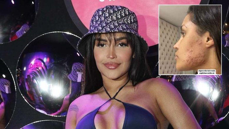 'Destruiu minha pele', diz Flay em desabafo sobre uso do 'chip da beleza'