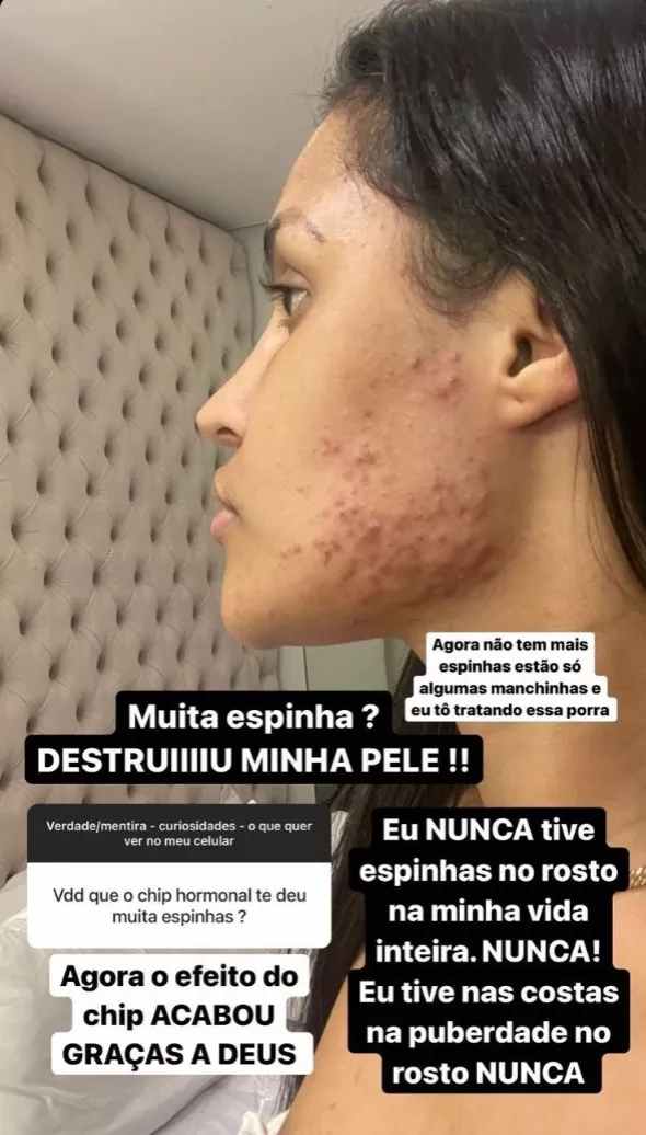 'Destruiu minha pele', diz Flay em desabafo sobre uso do 'chip da beleza' 4 'Destruiu minha pele', diz Flay em desabafo sobre uso do 'chip da beleza'