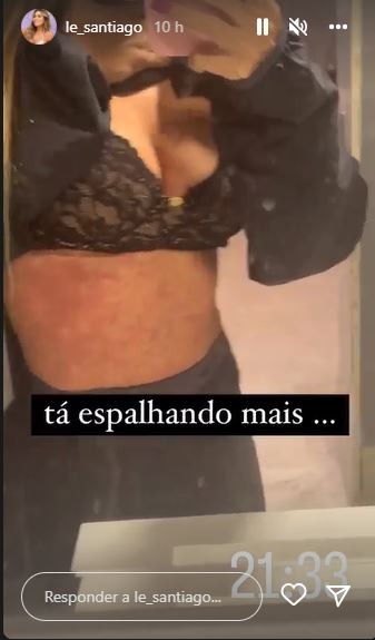 Ex-BBB Letícia Santiago mostra corpo com inflamação e aguarda por diagnóstico